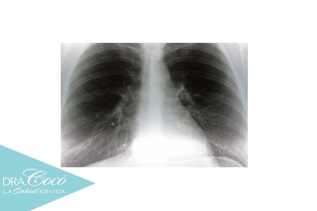 cómo-combatir-el-enfisema-pulmonar