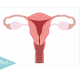 todo-sobre-los-miomas-uterinos